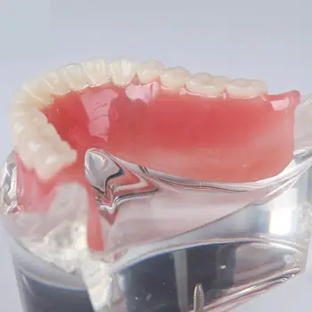 Демонстрационен модел за изучаване на зъбите Overdenture Inferior 4 Импланти
